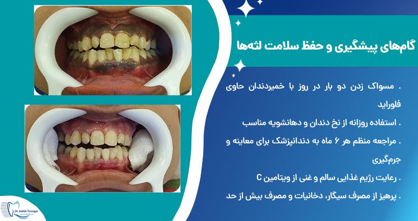 گام‌های پیشگیری و حفظ سلامت لثه‌ها
